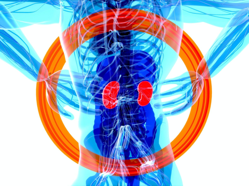 pedras nos rins e infertilidade